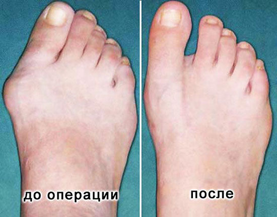 Фото «до и после» операции удаления «шишки» на ногих