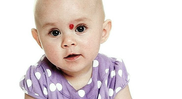 Фото ребенка с гемангиомой на лбу