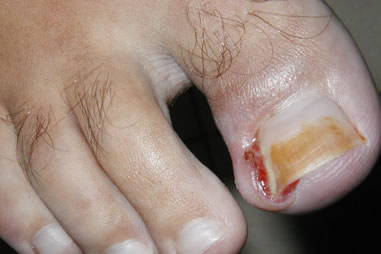 После операции по удалению вросшего ногтя