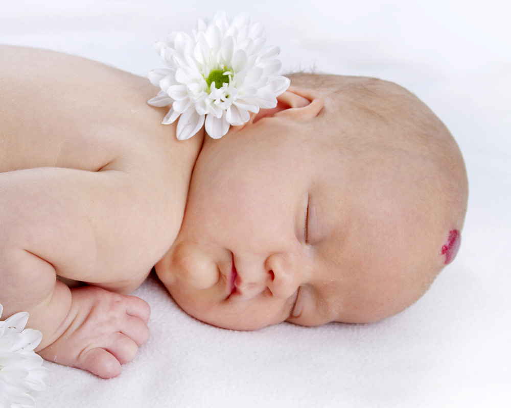Фотография младенца с гемангиомой на лобной части головы